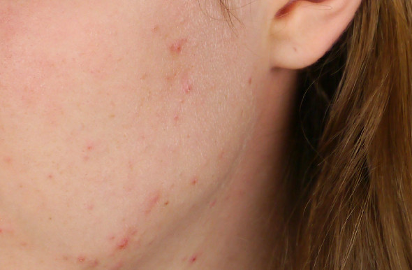 dermatology-before