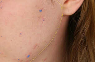 Dermatological red patches quantification